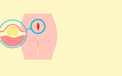 Understanding Pilonidal Disease-Causes, Symptoms, and Treatment Options